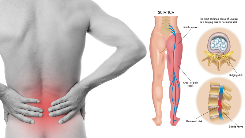 sciatica treatment